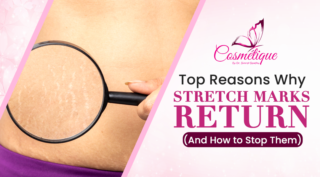 Top Reasons Why Stretch Marks Return (And How to Stop Them)